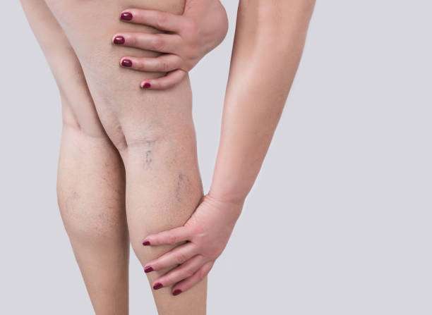 Woman with varicose veins, seeking comfort with compression socks for women.